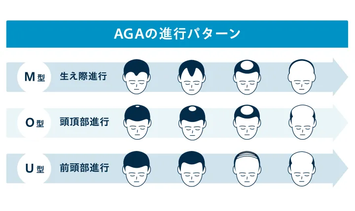 AGA進行パターンは3つ